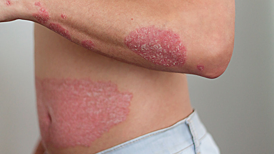 Why is my Psoriasis "Spreading"