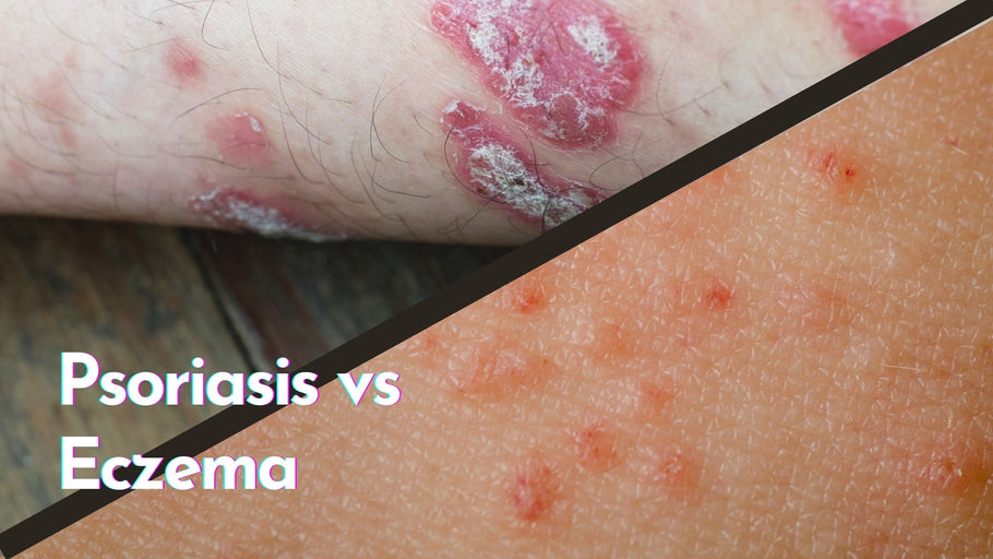 What’s the Difference Between Psoriasis and Eczema?