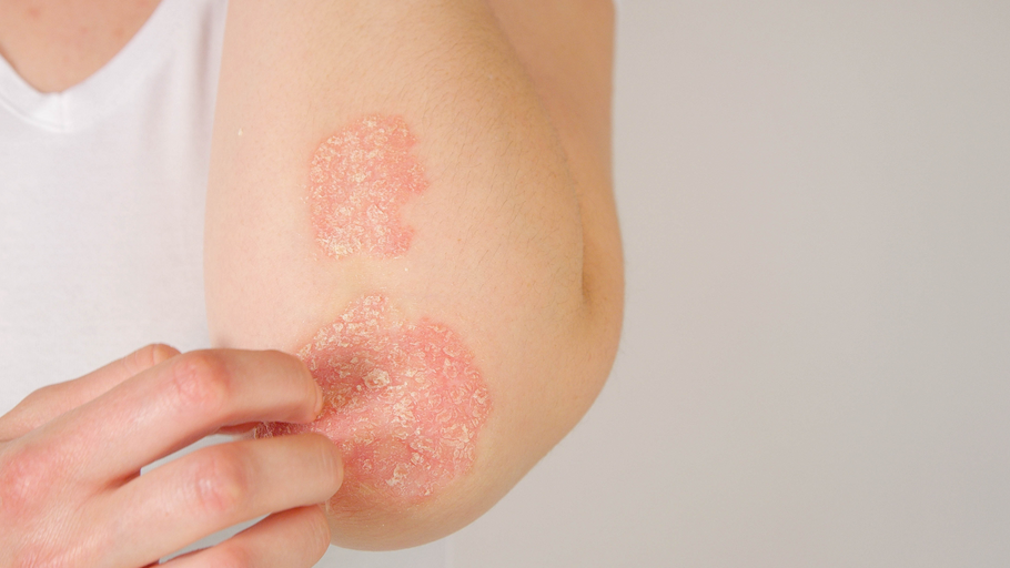What's Triggering Your Psoriasis? 4 Ways to Find Out