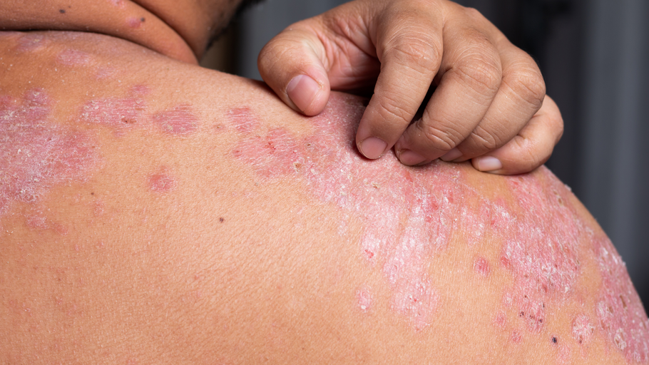 What Is Psoriasis?