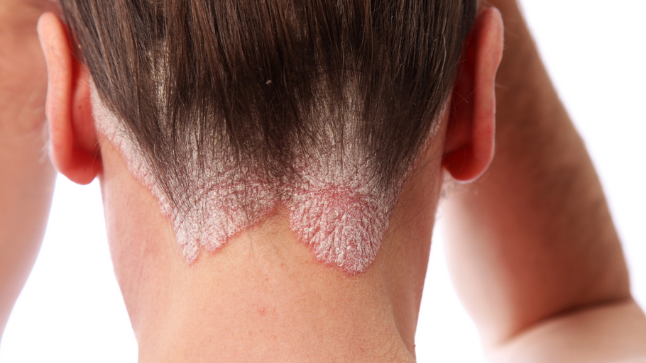 Causes and Triggers of Psoriasis