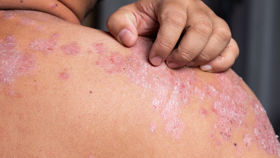 Most Common Types of Psoriasis: Which Type Do You Have?