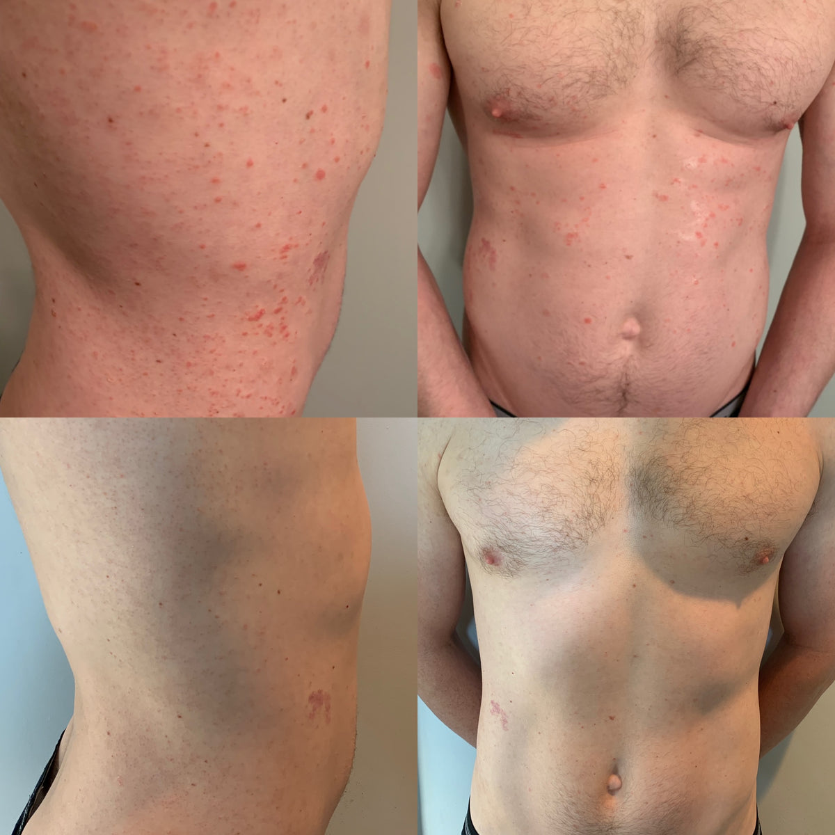 Kenkoderm Soap Results - Psoriasis Before and After